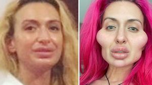 Foto: Transformasi Model dengan Pipi Terbesar, Before-After Suntik Filler