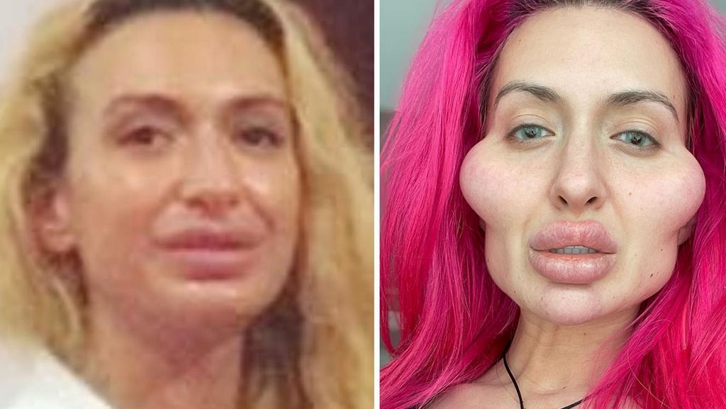 Foto: Transformasi Model dengan Pipi Terbesar, Before-After Suntik Filler Foto: Transformasi Model dengan Pipi Terbesar, Before-After Suntik Filler