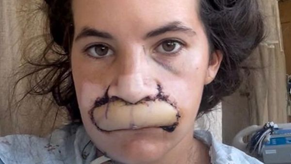 Transformasi Wanita yang Bibirnya Lepas Digigit Anjing, Kini Cangkok Bibir