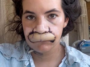 Transformasi Wanita yang Bibirnya Lepas Digigit Anjing, Kini Cangkok Bibir