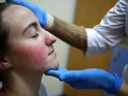 Deteksi Dini Penyakit Lupus, Ini yang Dilakukan Kemenkes