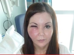 Penampakan Wanita yang Gagal Filler, Wajah Bengkak dan Hampir Buta