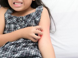 Mengapa Timbul Rasa Gatal Setelah Digigit Nyamuk? Ini Cara Meredakannya