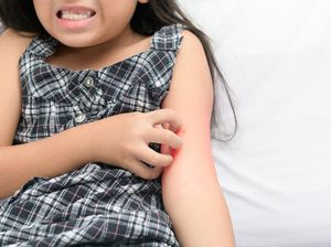 Mengapa Timbul Rasa Gatal Setelah Digigit Nyamuk? Ini Cara Meredakannya Mengapa Timbul Rasa Gatal Setelah Digigit Nyamuk? Ini Cara Meredakannya