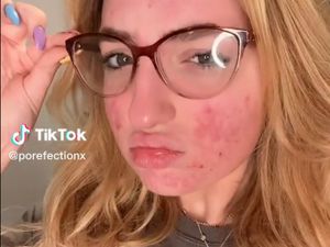 Ratu Kecantikan Berjerawat Diblokir TikTok, Kontennya Disebut Mengerikan Ratu Kecantikan Berjerawat Diblokir TikTok, Kontennya Disebut Mengerikan