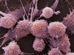 Kanker Mulai Serang Remaja Belasan Tahun, Gaya Hidup Jadi Penyebab