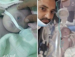 Heboh Ada Bayi Bermata Satu di Yaman, Begini Kejadiannya