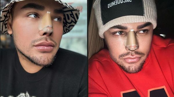 Deretan Artis yang Jalani Operasi Hidung, Ivan Gunawan Jadi Sorotan