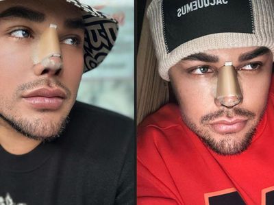 Deretan Artis yang Jalani Operasi Hidung, Ivan Gunawan Jadi Sorotan