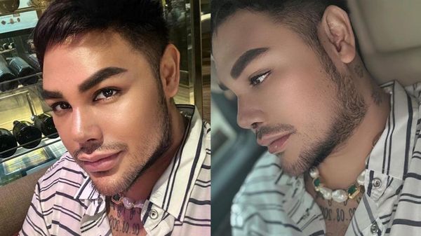 6 Potret Penampilan Hidung Baru Ivan Gunawan Pasca Operasi di Turki