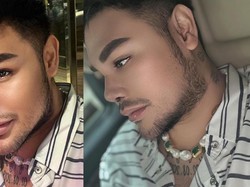 Jajal Oplas di Turki, Ivan Gunawan Harus Pakai Perban Hidung Saat Tidur