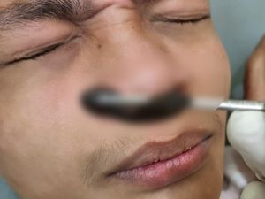 Mengejutkan Lintah Segede Jempol Tinggal di Hidung Pria 2 Pekan Mengejutkan Lintah Segede Jempol Tinggal di Hidung Pria 2 Pekan