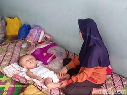 Bocah Idap Hidrosefalus di Jambi Butuh Bantuan