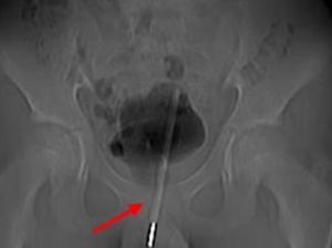 Petaka gegara Onani, Termometer Nyangkut di Alat Vital Petaka gegara Onani, Termometer Nyangkut di Alat Vital