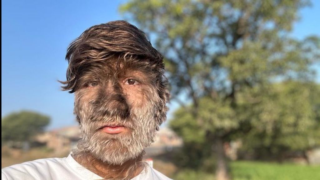 6 Foto Remaja India Kena Kondisi Langka, Wajahnya Tertutup Rambut Bak Serigala 6 Foto Remaja India Kena Kondisi Langka, Wajahnya Tertutup Rambut Bak Serigala