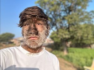 6 Foto Remaja India Kena Kondisi Langka, Wajahnya Tertutup Rambut Bak Serigala 6 Foto Remaja India Kena Kondisi Langka, Wajahnya Tertutup Rambut Bak Serigala