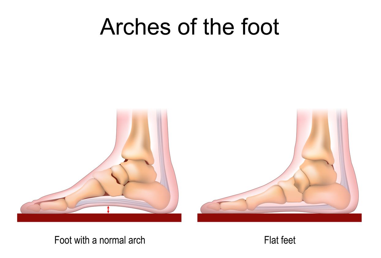 Ilustrasi kaki normal dan kaki rata atau flat feet