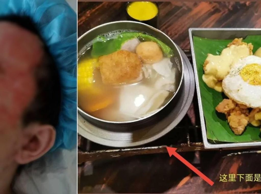 Kena Ledakan Saat Makan Hot Pot, Pria Ini Hanya Dapat Ganti Kupon Makan Kena Ledakan Saat Makan Hot Pot, Pria Ini Hanya Dapat Ganti Kupon Makan