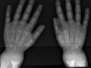 Osteomalasia Adalah: Penyebab, Gejala, dan Cara Mengobati