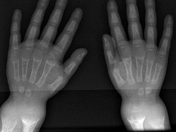 Osteomalasia Adalah: Penyebab, Gejala, dan Cara Mengobati