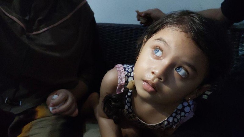 Mari Bantu Zahida, Bocah Penderita Kelainan Penglihatan