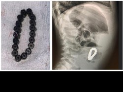 Viral Bocah 4 Tahun Ngeluh Sakit Perut, Ternyata Benda Ini Bersarang di Tubuh