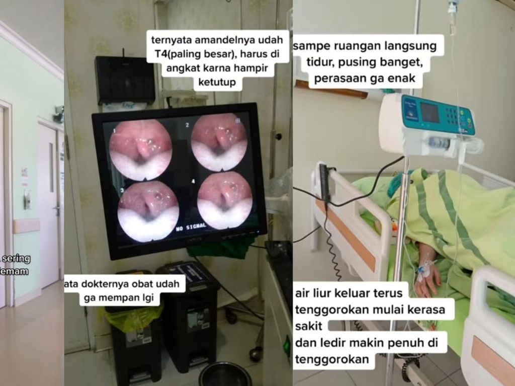 Viral Wanita Kena Radang Amandel, Mungkinkah Sembuh Tanpa Operasi?
