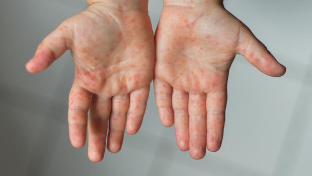 Enterovirus Legs hands mouth Rash on the body of a child Cocksackie virus