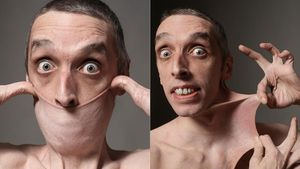 6 Potret Pria Berkulit Paling Elastis di Dunia, Kulit Perutnya Bisa Melebar 15 Cm
