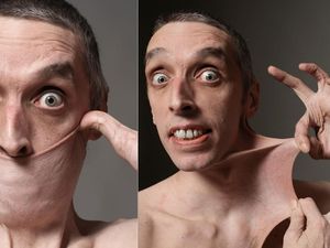 6 Potret Pria Berkulit Paling Elastis di Dunia, Kulit Perutnya Bisa Melebar 15 Cm