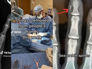 Ngeri! Dokter Bedah Ungkap Benda-benda Aneh yang Ditemukan di Tubuh Pasien