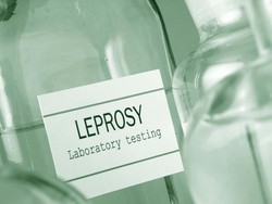 Peringatan Hari Kusta Sedunia 2024 dan Doa Rasulullah Hindari Penyakit Itu