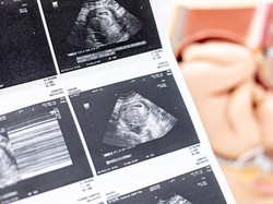 Video: Penjelasan Dokter soal Perbedaan Autisme dan Down Syndrome