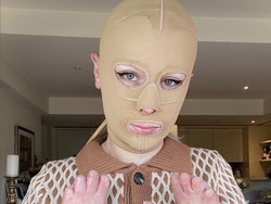 Wanita Korban Erupsi Gunung Api Buka Topeng Setelah 2 Tahun, Begini Wajahnya