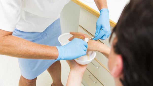Severe burns in mans index finger...nurse removing big blister with liquid after injury