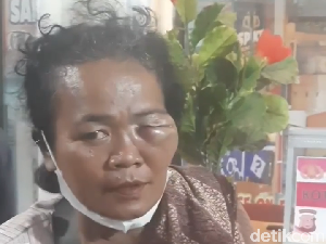 Viral Wajah Wanita di Siantar Bengkak Diduga Dihajar Sekuriti PTPN 3