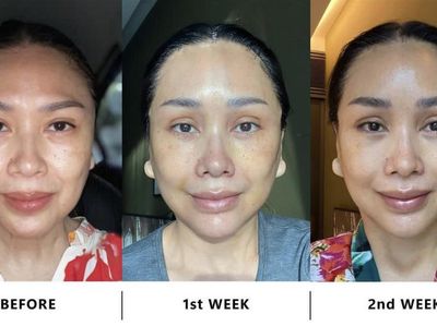 6 Potret Titi DJ Jalani Prosedur Anti Aging Surgery di Korsel, Begini Hasilnya