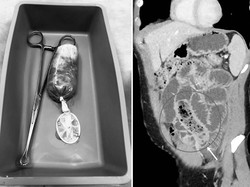 Duh! Pria Ini Nekat Makan Pisang Dibungkus Kondom, Dokter Kaget Liat Ususnya