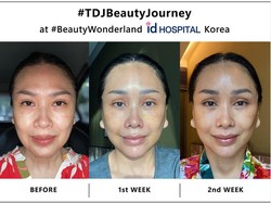 Fantastis! Segini Biaya Oplas Anti-aging Titi DJ