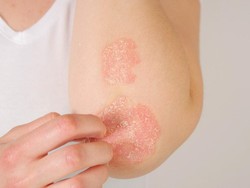 10 Contoh Penyakit Autoimun yang Paling Umum Terjadi