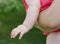 Ahli Jelaskan Penyebab Terjadinya KLB Campak di Indonesia