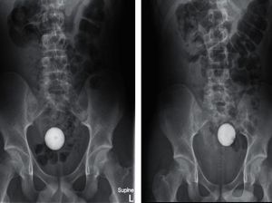 Ngilu! Viral Foto X-Ray Tunjukkan Momen Usus Remaja Kemasukan Bola Golf