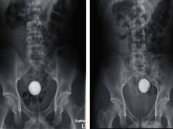 Ngilu! Viral Foto X-Ray Tunjukkan Momen Usus Remaja Kemasukan Bola Golf