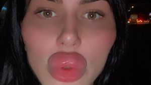 8 Foto Selebgram Terobsesi Oplas Sampai Diblokir Dokter, Bibirnya Jadi Begini
