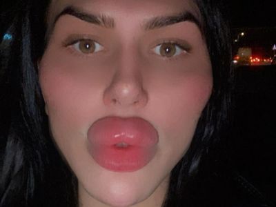 8 Foto Selebgram Terobsesi Oplas Sampai Diblokir Dokter, Bibirnya Jadi Begini