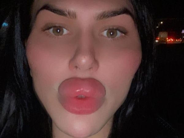8 Foto Selebgram Terobsesi Oplas Sampai Diblokir Dokter, Bibirnya Jadi Begini
