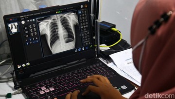 Klaim Menyesatkan Influencer Sebut TBC Bisa Dicegah-Diobati dengan Herbal