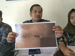 Geger Miss V ABG di Palembang Membusuk Pasca Operasi Usus Buntu