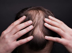 Madevine Hair Oil Ekstrak Rosemary Oil, Cegah Kebotakan Sejak Dini