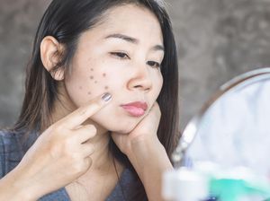 Dark Spot Adalah Bercak Gelap pada Kulit, Begini Cara Menghilangkannya! Dark Spot Adalah Bercak Gelap pada Kulit, Begini Cara Menghilangkannya!